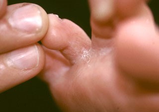 athlete's foot between toes