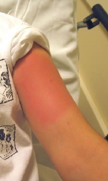 bee sting of upper arm